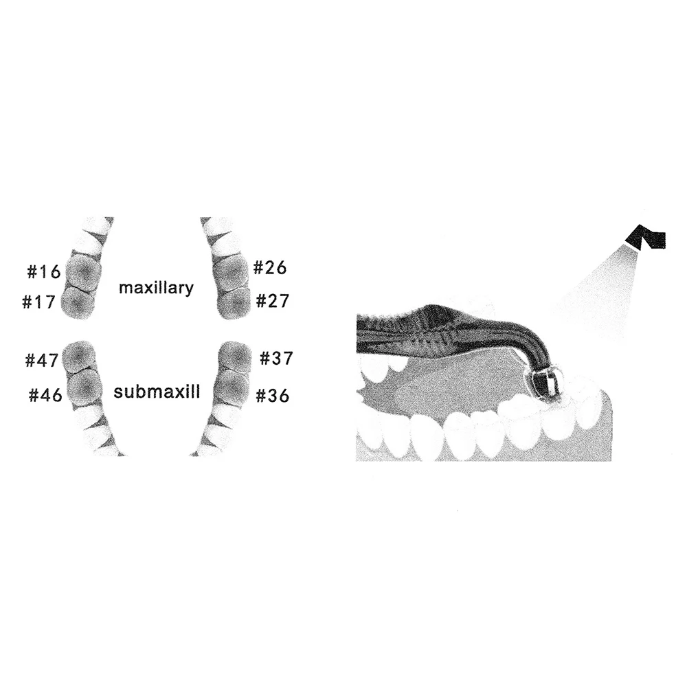 Dental Orthodontic Posterior T - 3D Printing Orthodontics avaliação e preço